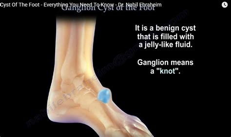 ganglion cyst on bottom of foot treatment of ganglion cysts some data on results