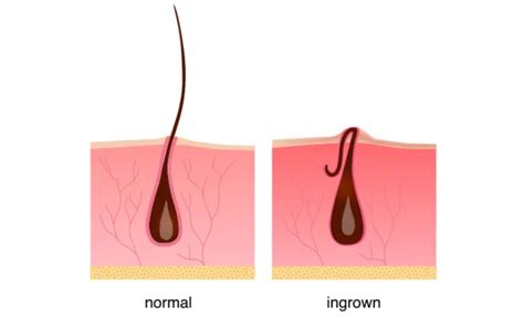 3 Ways To Treat Infected Ingrown Hair The Tech Edvocate