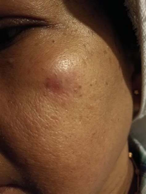 Skin Concerns My Mum Had A Tiny Bump Under Her Skin For A Couple Of