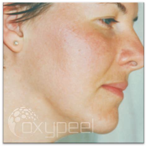 Adult Acne And Post Inflammatory Hyperpigmentation Oxypeel Advanced