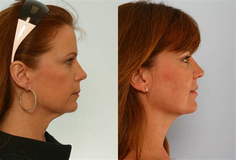 Neck Lift Surgery Things You Should Know Flymedi