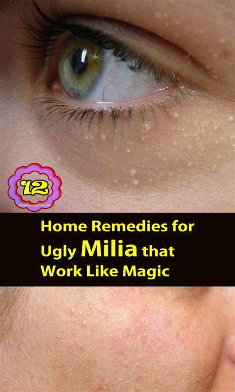 Hair Removal Permanent Facials Milia Also Called Milk Spot On Skin