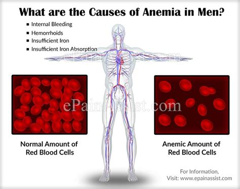 causes of anemia in men know its types symptoms treatment