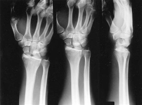 Radial Styloid Fractures Plastic Surgery Key