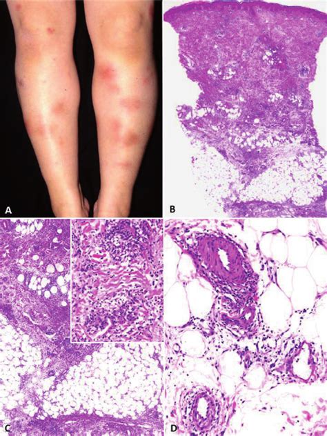 Clinicopathological Features Of An Erythema Nodosum Type Lesion Case