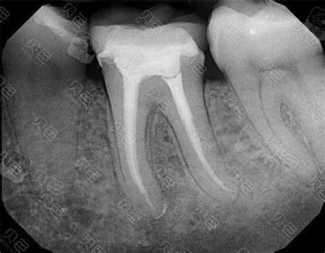 根管治疗步骤图解让你清晰了解根管治疗整个过程 贝色口腔