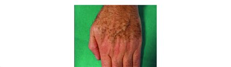 Hyperpigmentation Of Back Of The Hands Download Scientific Diagram