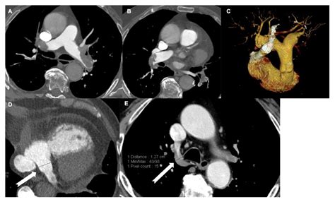 Tomography Free Full Text Acute Pulmonary Embolism Prognostic Role Of Computed Tomography
