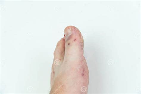 Human Leg With Dermatitis Allergy Rash Close Up Of Maleand X27s Foot