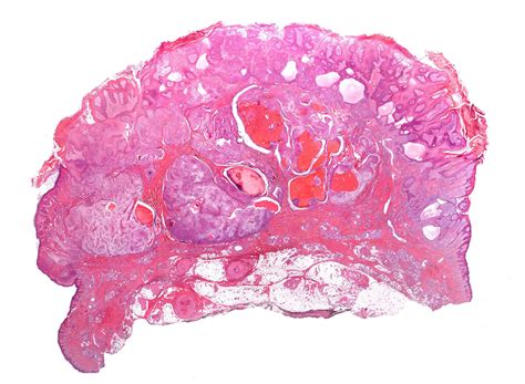 Unknown A Woman With Nodular Lesion In A Patient With Diabetes Mellitus