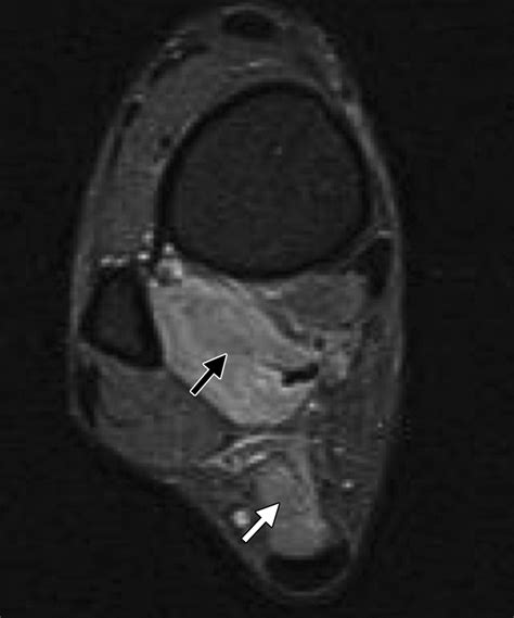 Mr Imaging Of Entrapment Neuropathies Of The Lower Extremity