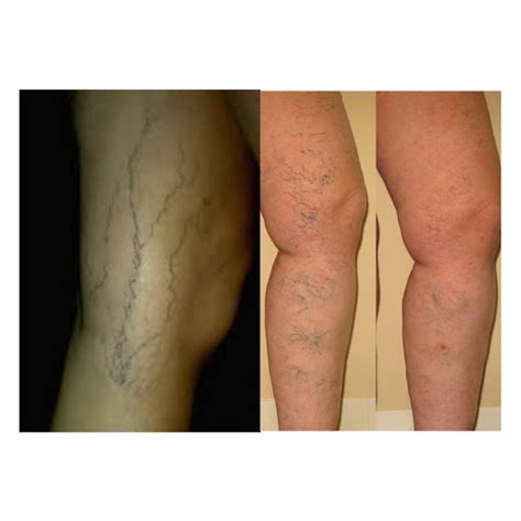 Treatment For Visible Veins Sozaya