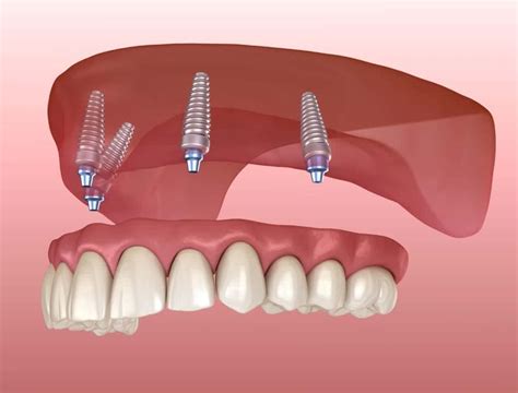 3 Types Of Dental Prosthesis Laurich Dentistry