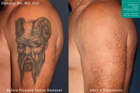 Laser Tattoo Removal Medical Spa San Diego Ca Clderm