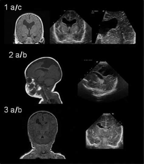 Representative Images Of Infants With Severe Brain Abnormalities Panel