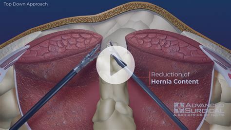 Incisional Hernia Advanced Surgical Bariatrics Of NJ