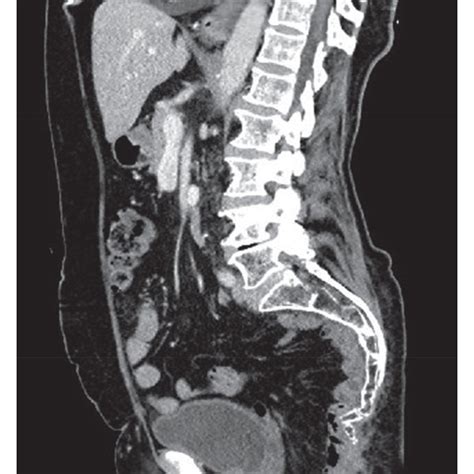 The Sagittal Image Of The Pelvis After Perineal Hernia Repair