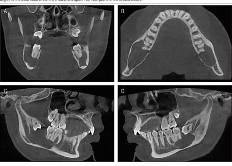 Figure 2 From Bilateral Mandibular Dentigerous Cysts In A Non Syndromic