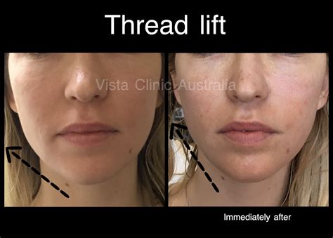 Lifting Threads Before And After Vista Clinic Melbourne