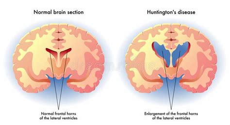 It is manifested by motor, cognitive and psychiatric disorders that will progressively increase. CBD for Huntington's Disease - The Real Truth | Cheef ...