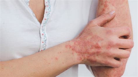 Naturally Heal Skin Irritations Like Eczema Psoriasis And Hives