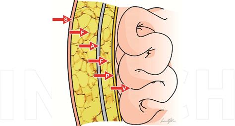 Figure 1 From The Use Of Biomaterials To Treat Abdominal Hernias