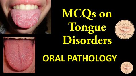 Mcqs In Oral Pathology Tongue Disorders Youtube