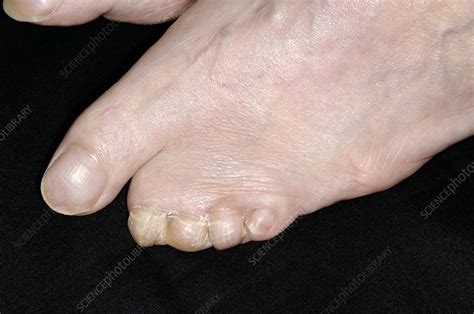 Congenital Webbed Toes Stock Image C Science Photo Library