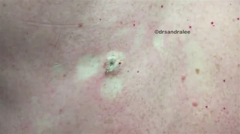 Dr Pimple Popper See The Biggest Blackhead Ever Squeezed Out Of A Back