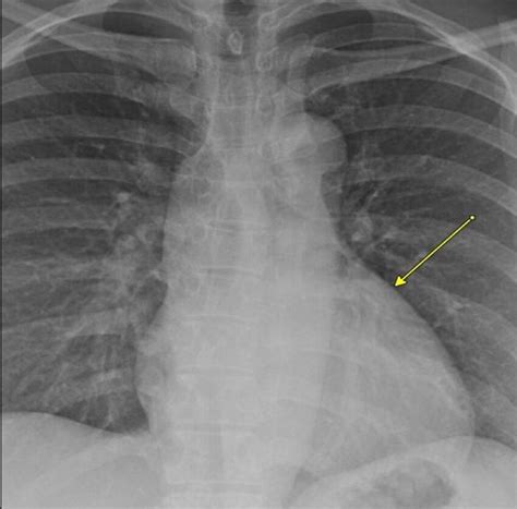 Pa Chest Radiograph Mildly Enlarged Left Atrial Sillouhette Yellow