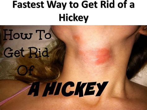 7 fastest way to get rid of a hickey