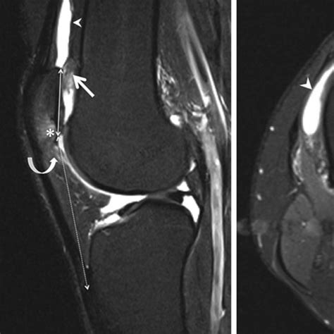 Fat Pad Impingement Syndromes Of The Knee Radiology Reference Article
