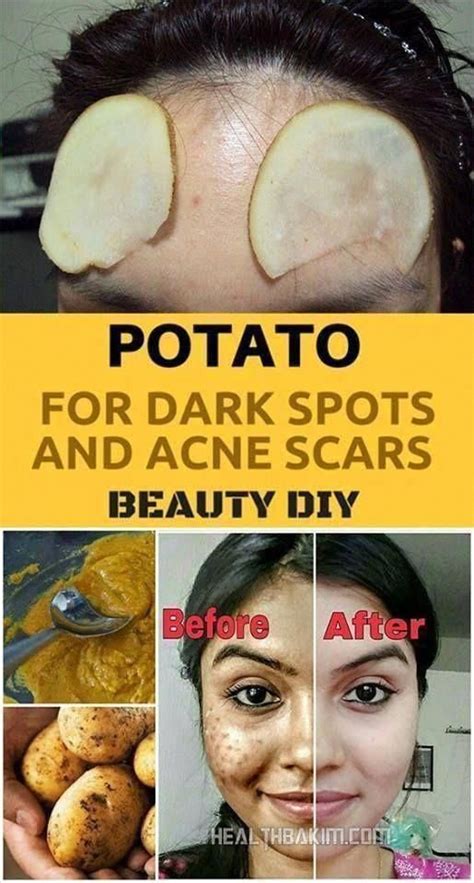 How To Naturally Remove Brown Spots On Face Home Remedies Brown