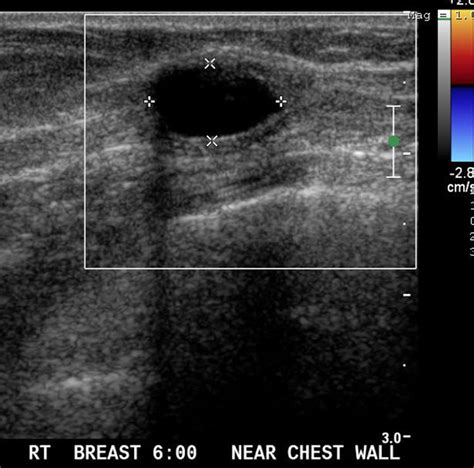 62 Year Old Female With Epidermoid Cyst Of The Breast Ultrasound Shows