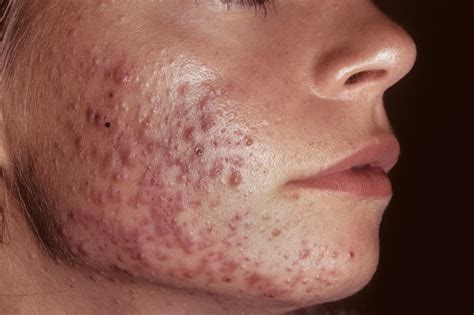 Hormonal Antiandrogen Therapy For Acne May Help Reduce Antibiotic Use