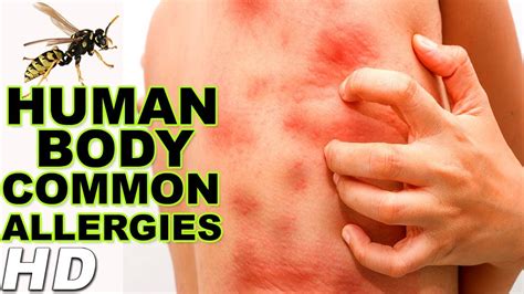 5 Common Allergies In Human Body Top Common Allergies Healthy Life Aim Youtube