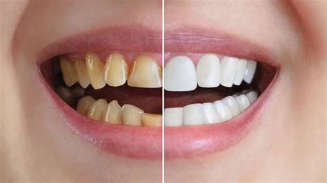 Expert Shares Actual Cause Behind Teeth Turning Yellow Know How To Get