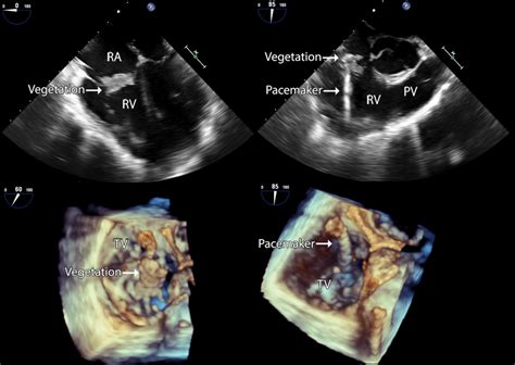 Tee Image Of This Patient With Pacemaker Induced Endocarditis Of