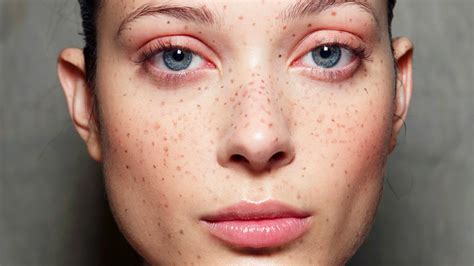 People Are Tattooing Freckles On Their Face And This Is What It Looks