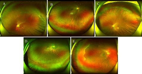 Wide Field Of Fundus Color Photo Show The Different Types Of Prcs A
