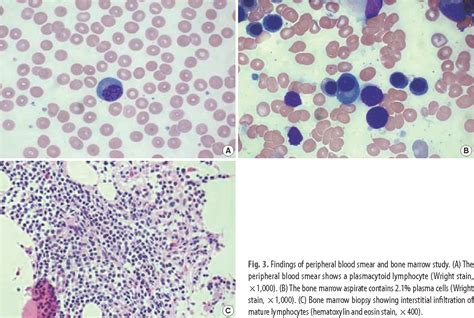 Figure 3 From A Case Of Monoclonal Gammopathy In Extranodal Marginal