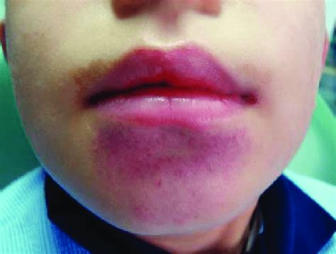 Lip Licking Dermatitis Due To Sucking A Ball All Day Download