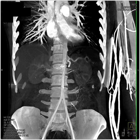 Vascular Injury Left Femoral Artery Vascular Case Studies Ctisus Ct