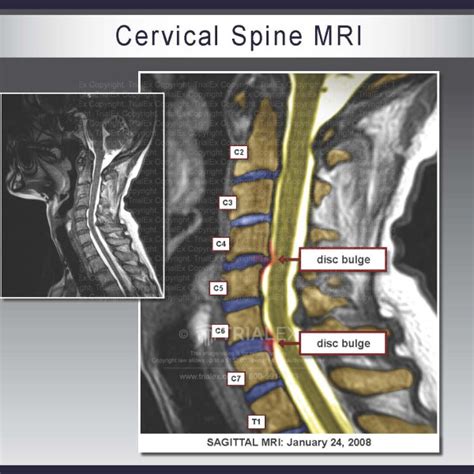 Cervical Spine Mri Trialexhibits Inc