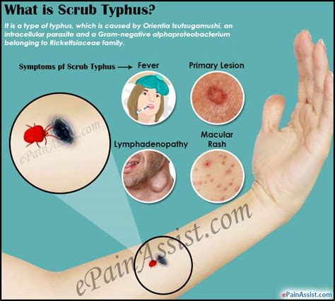 Scrub Typhuscausessymptomstreatmentdiagnosis