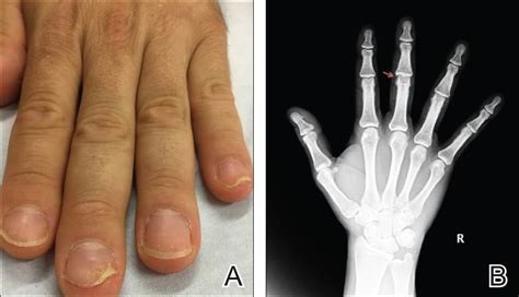 Clinical Pearl Early Diagnosis Of Nail Psoriasis And Psoriatic