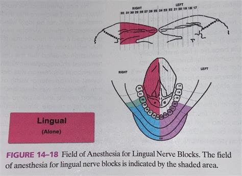 Lingual Nerve Block L Or Lnb Flashcards Quizlet