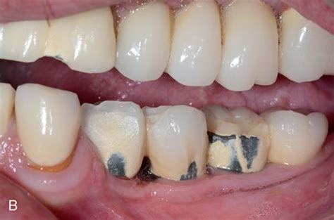 Porcelain Full Coverage And Partial Coverage Restorations Pocket
