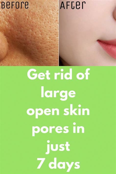 Get Rid Of Large Open Skin Pores In Just 7 Days Large Open Skin Pores