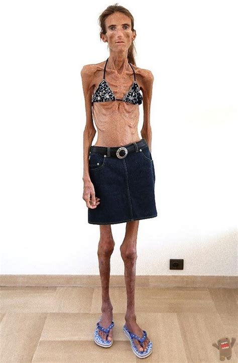 Valeria Levitinthe Worlds Thinnest Woman Campaigns Against Anorexia 5 The Citizens Of Fashion